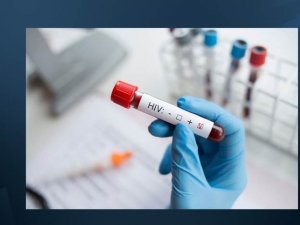 HIV virüsü tedavisinde umut verici çalışma